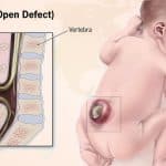 spina-bifida-feature